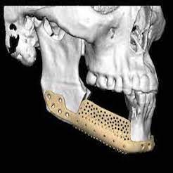 Scanning and 3D printing allow reconstruction of missing bones