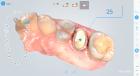 Aoralscan Dental intra oral 3D scanner