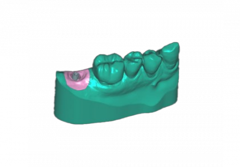 Formation CAO dentaire Exocad : module Model Creator